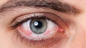 Pengobatan rumahan untuk infeksi mata