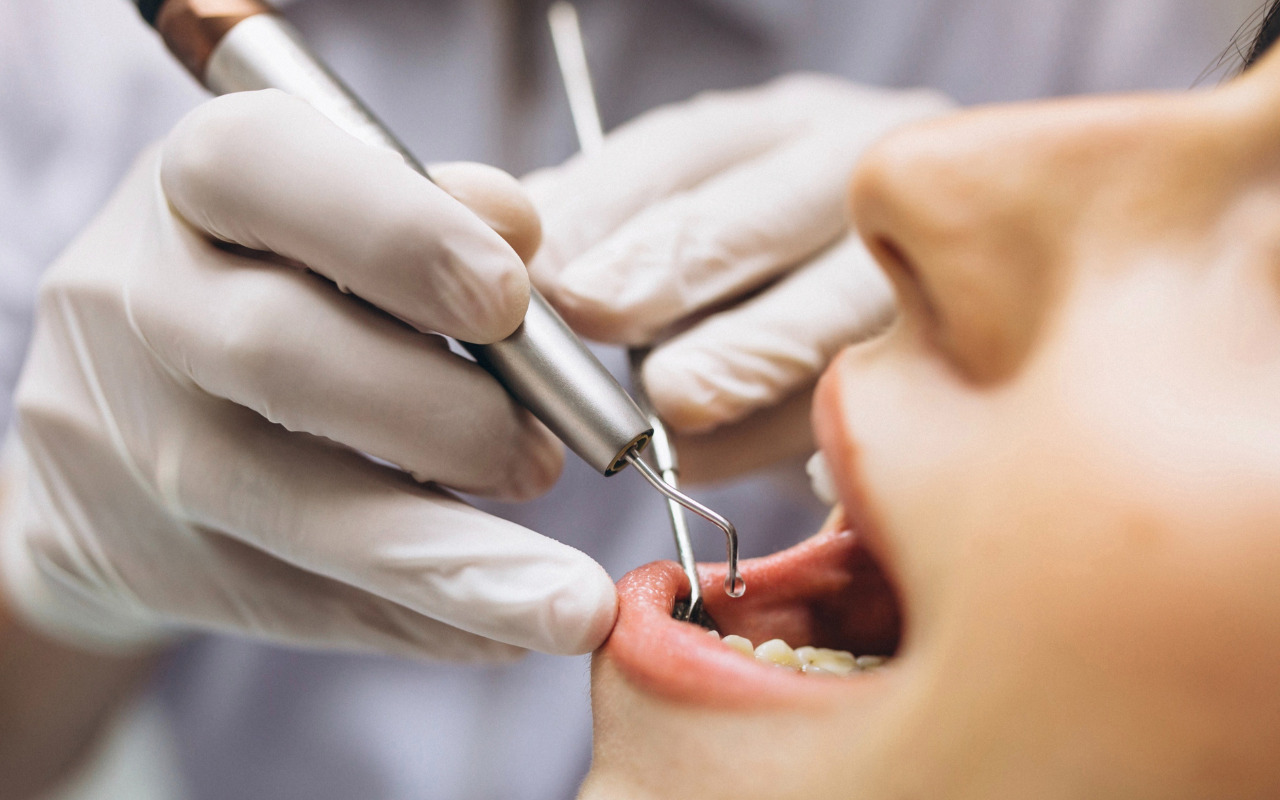 7 Perawatan Gigi yang Ditanggung BPJS Kesehatan
